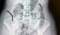 Boynuna takılan implant yemek borusunu yırtıp midesine düştü