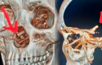 Beyninden çıkanlar şoke etti