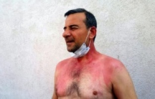 Edirne'de sigara dumanı kavgası! Kaynar suyla yaktı