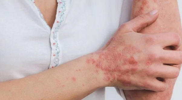 Uyuz vakalarında patlama